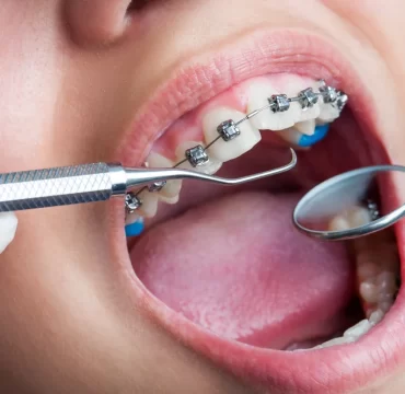 orthodontic-treatment